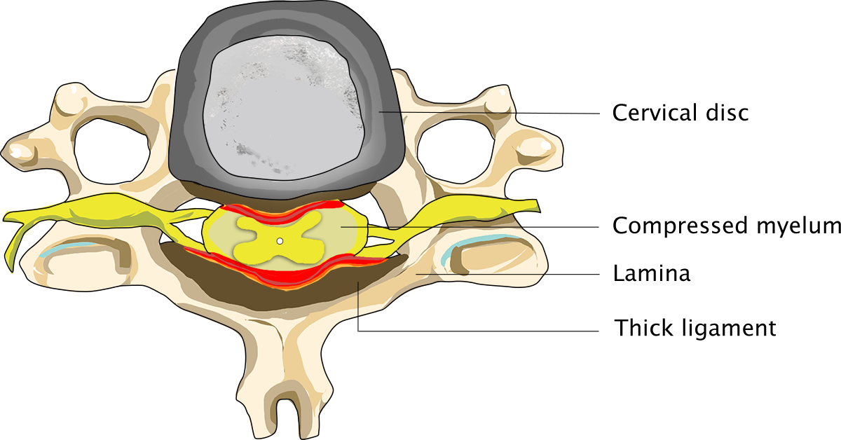 Cervical spinal stenosis Conditions Dr Schröder