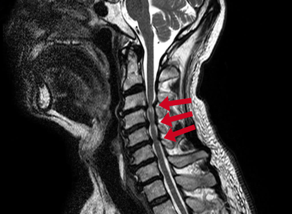Diagnosis of a cervical spinal stenosis