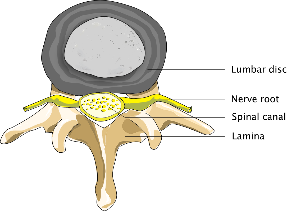 Spinal Stenosis - Neurosurgery