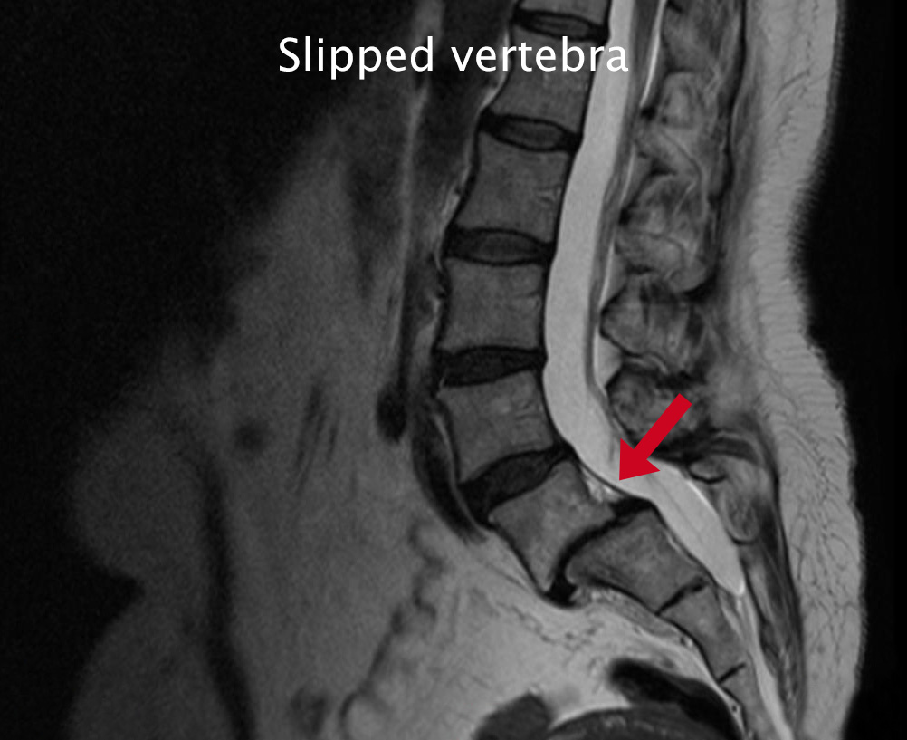 Diagnosis of spinal instability