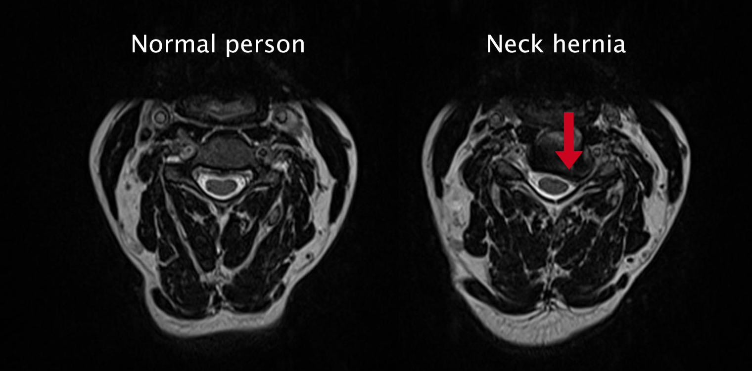 Diagnosis of a neck hernia