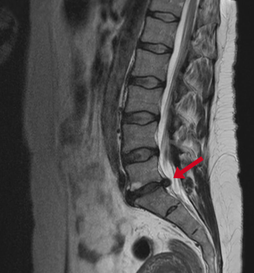 Diagnosis of a spinal hernia