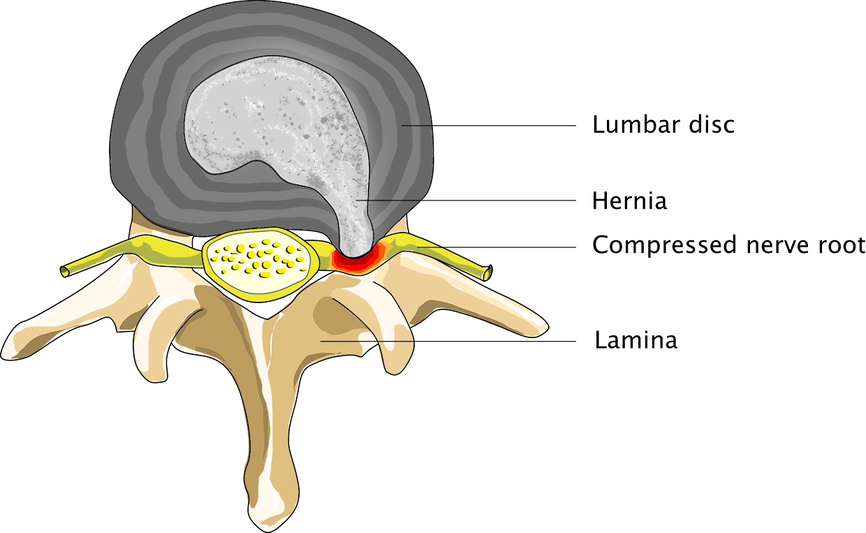 Patient suffering from spinal hernia