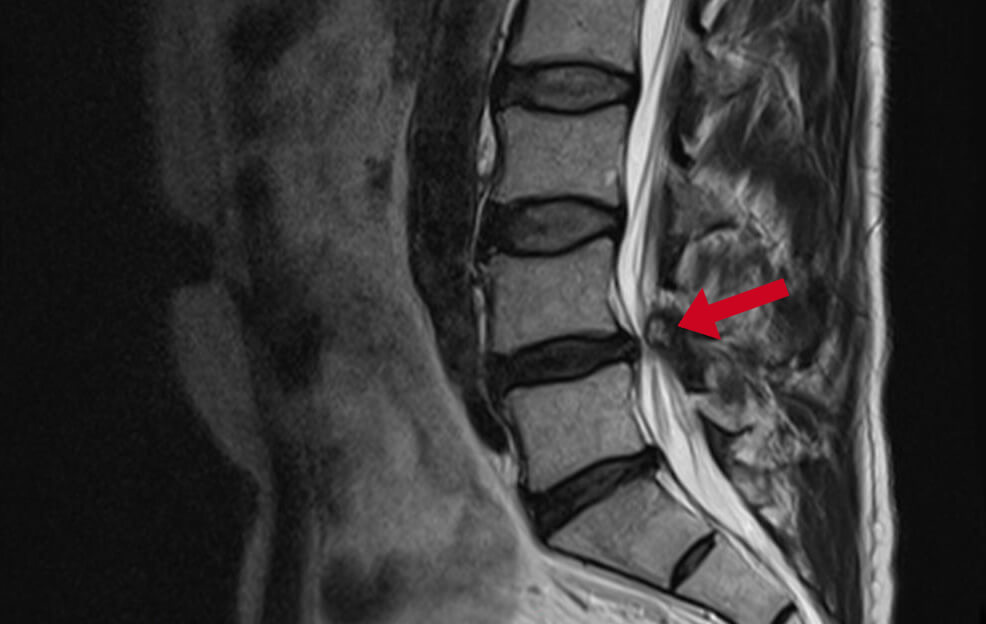 Diagnosis of a lumbar spinal stenosis